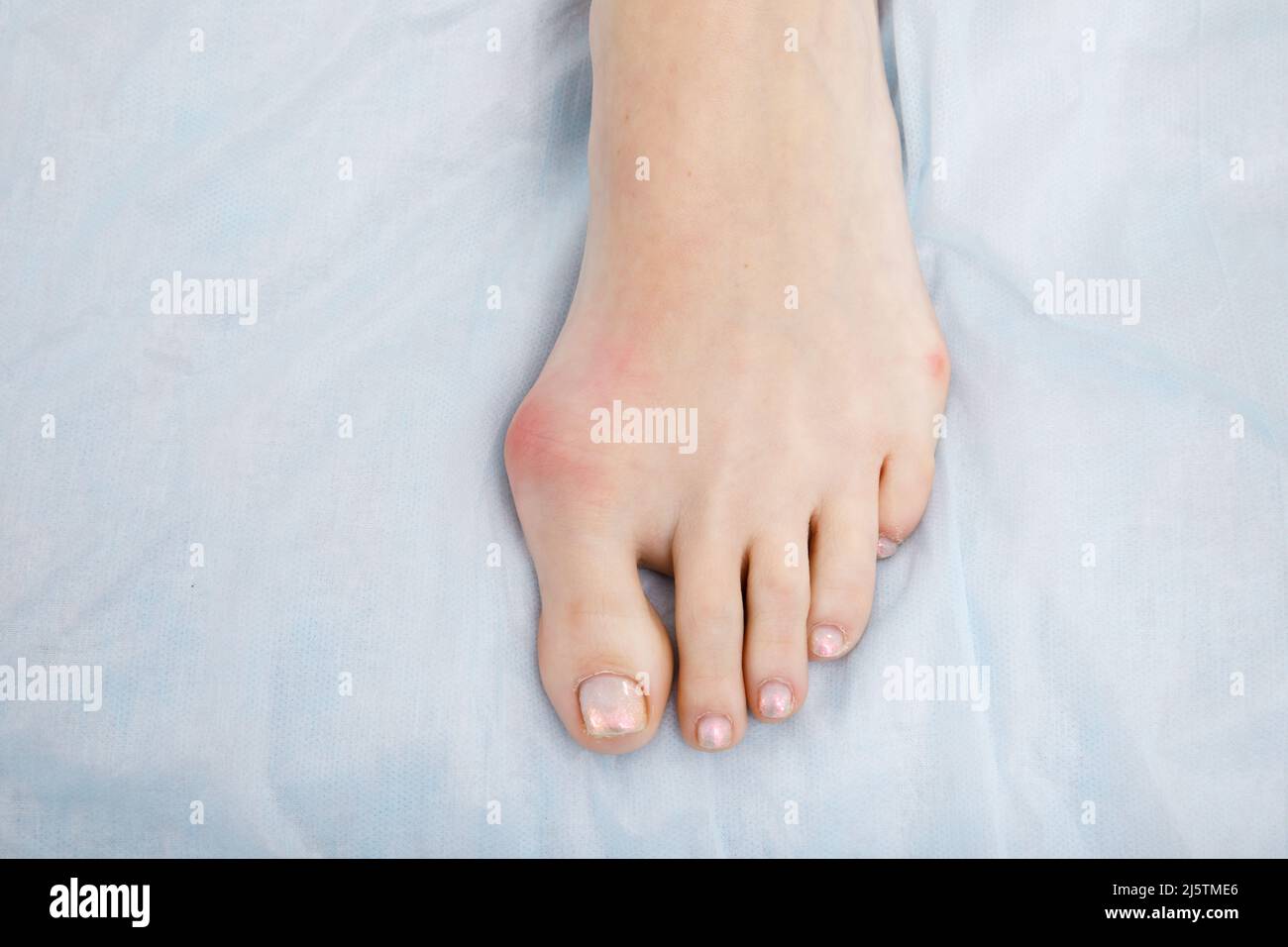 The woman suffers from inflammation of the big toe bone. Hallux valgus, bunion in foot on white background. Stock Photo