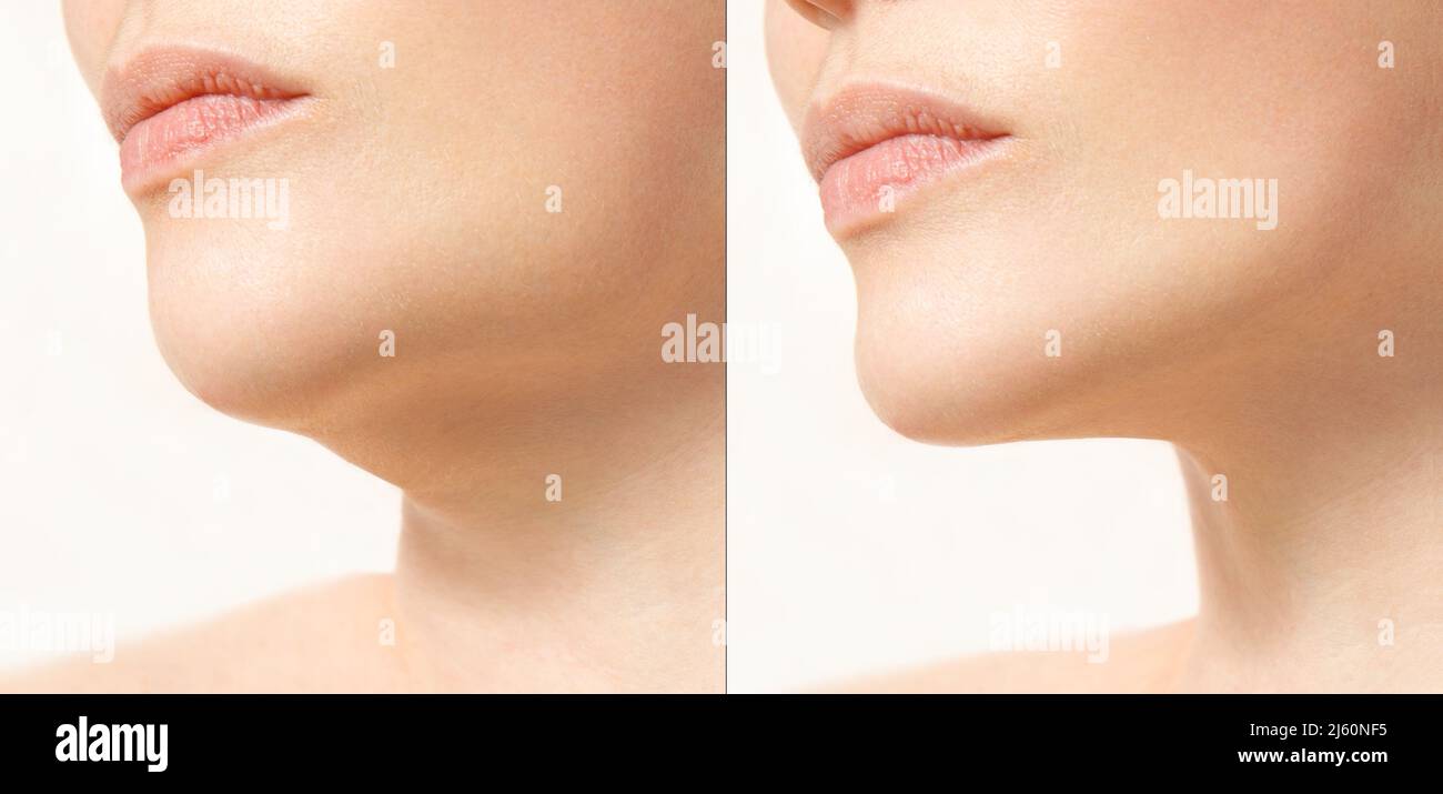 A close portrait of an aged woman before and after facial rejuvenation procedure. Correction of the chin shape liposuction of the neck. The result of Stock Photo