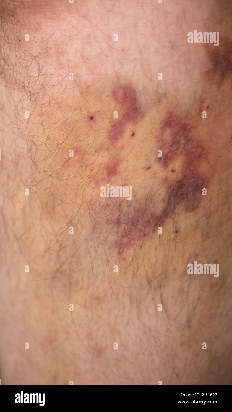 Large hematoma on the leg after injections for a medical operation. Stock Photo