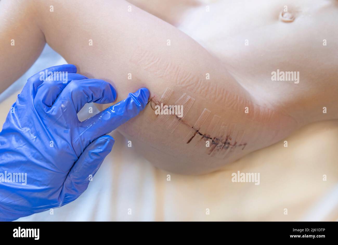 close-up of human skin with strips for sutures and wound closure or surgical tape after surgery on a child's leg. Stock Photo