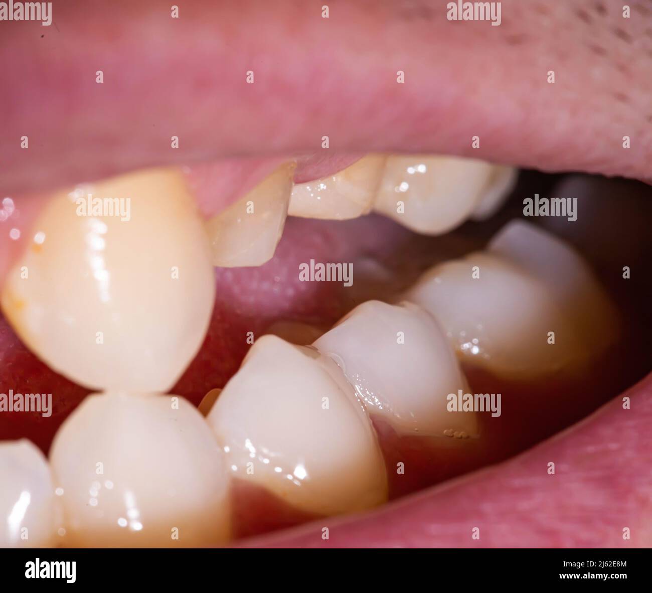 Grind teeth under a metalceramic crown in a man's mouth. Dental