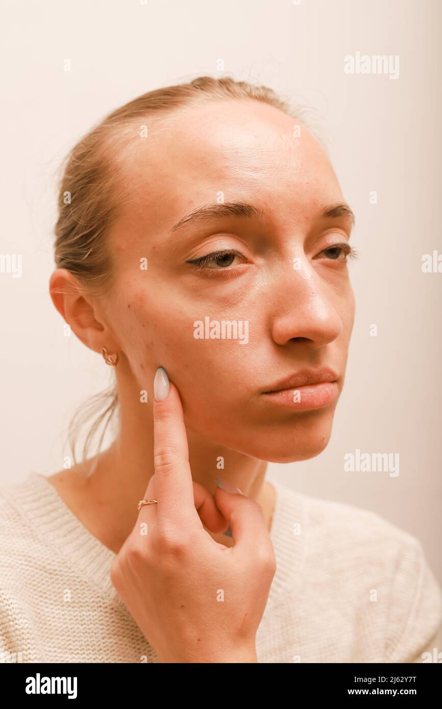 Teenage girl points a finger at her cheek with acne Stock Photo - Alamy