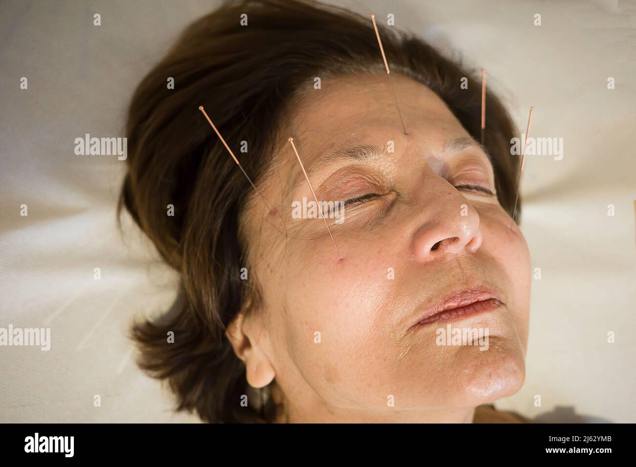 facial acupuncture Stock Photo