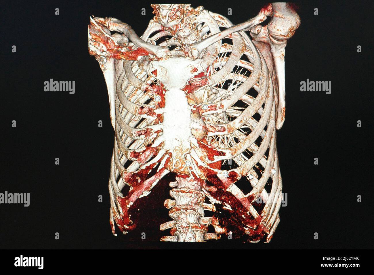 CT scan of the chest Stock Photo