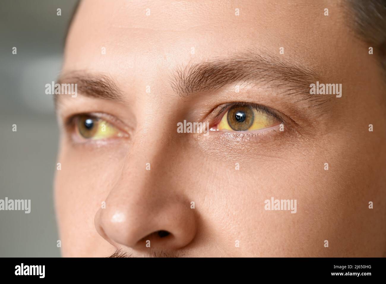 Man with yellow eyes, closeup. Hepatitis symptom Stock Photo Alamy