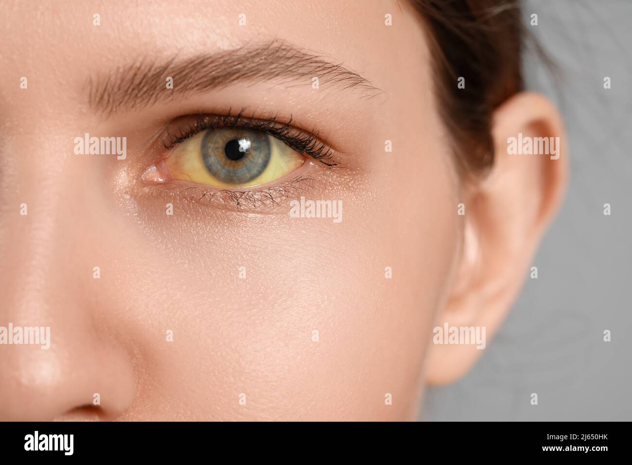 Young woman with yellow eyes, closeup. Hepatitis symptom Stock Photo