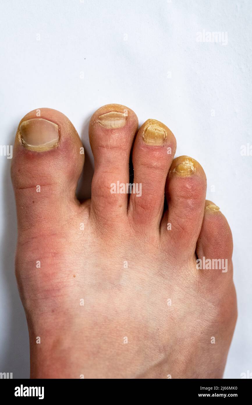 Adult man foot with the nail fungal infection. Stock Photo