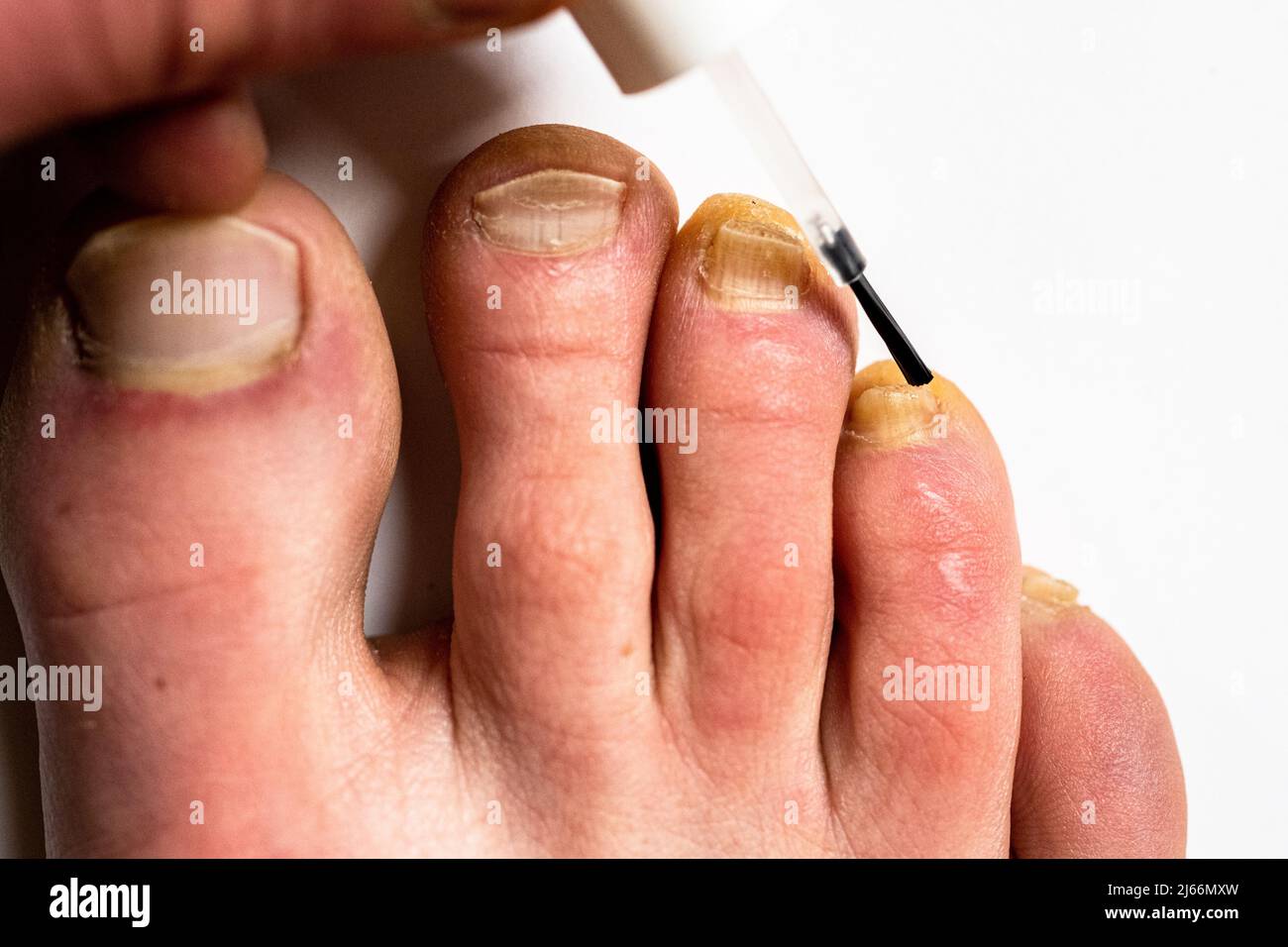 Using a varnish against nail fungus. Nail fungal infection treatment Stock  Photo - Alamy