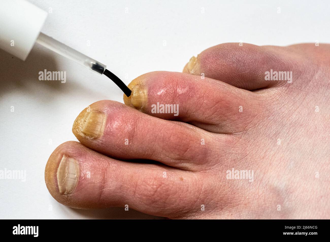 using a varnish against nail fungus nail fungal infection treatment 2J66NCG