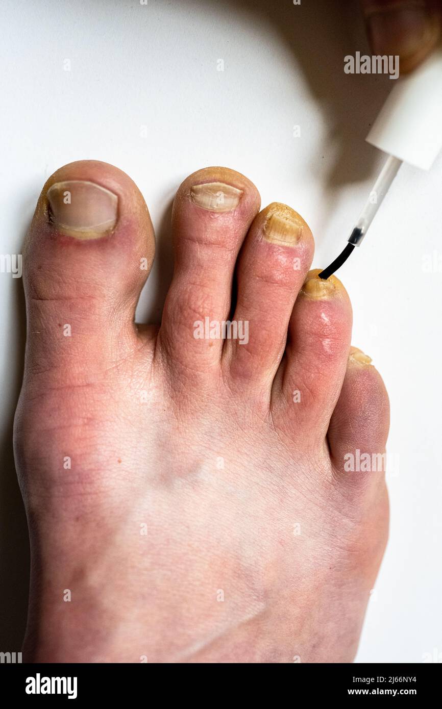 Fungal nail infection treatment: Try 1 of these 4 remedies!