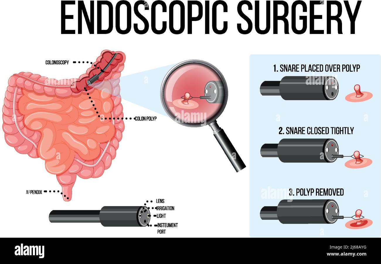 Diagram showing endoscopic surgery illustration Stock Vector Image
