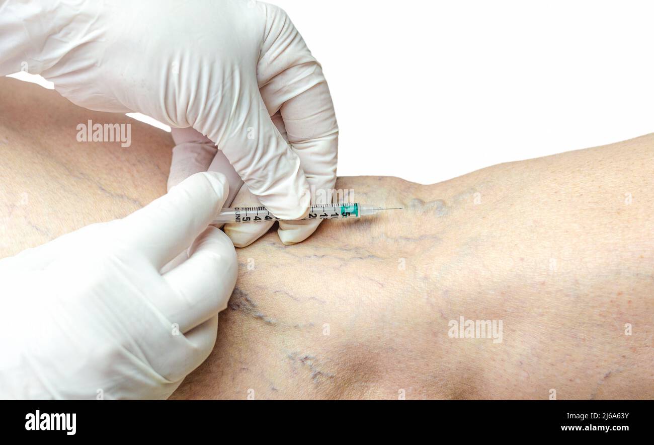Sclerotherapy  on the legs of an adult Caucasian male. Removal of varicose veins with injection by a doctor in white gloves. Atrophied veins from smok Stock Photo