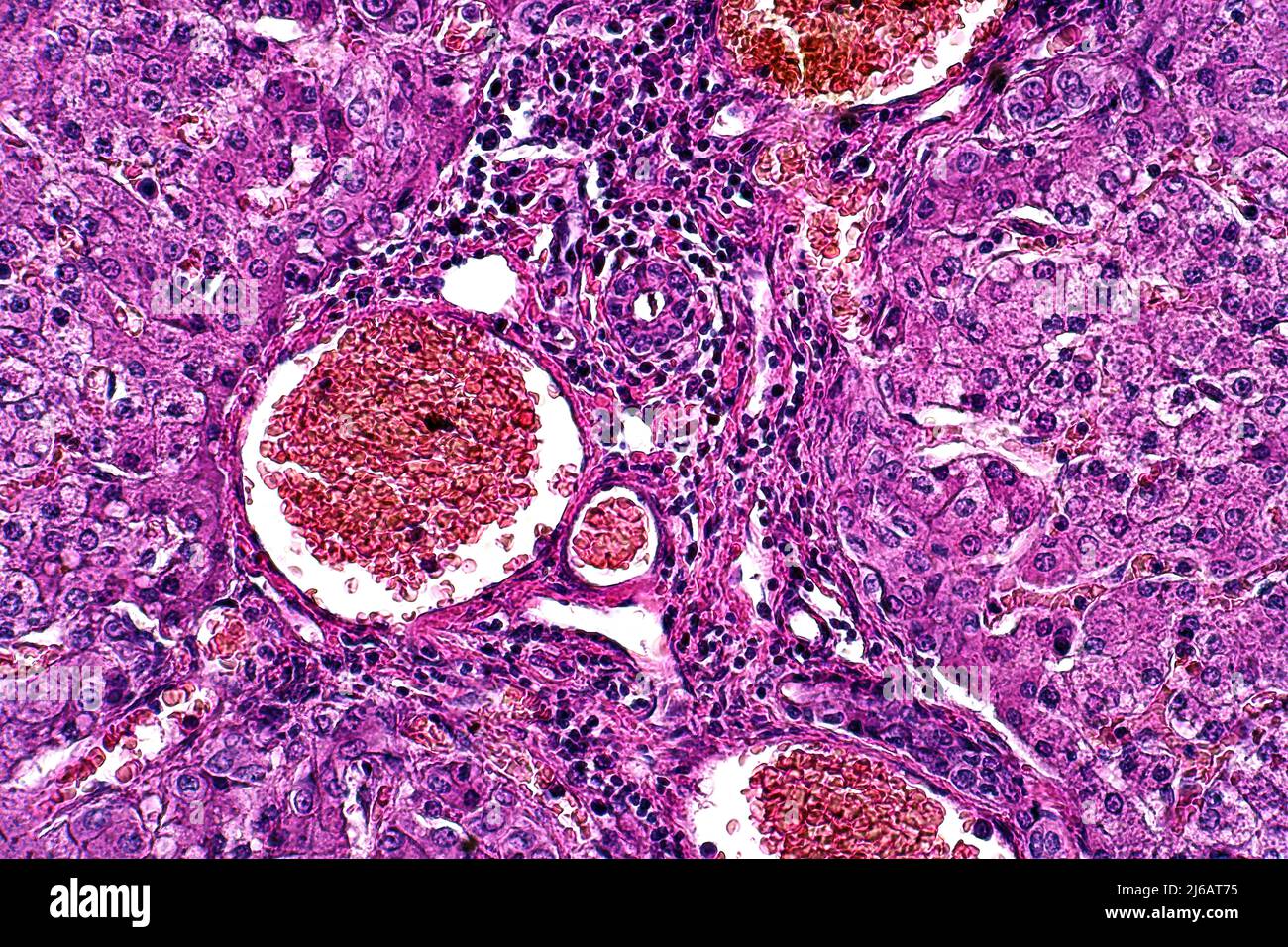 Liver degeneration, light micrograph Stock Photo