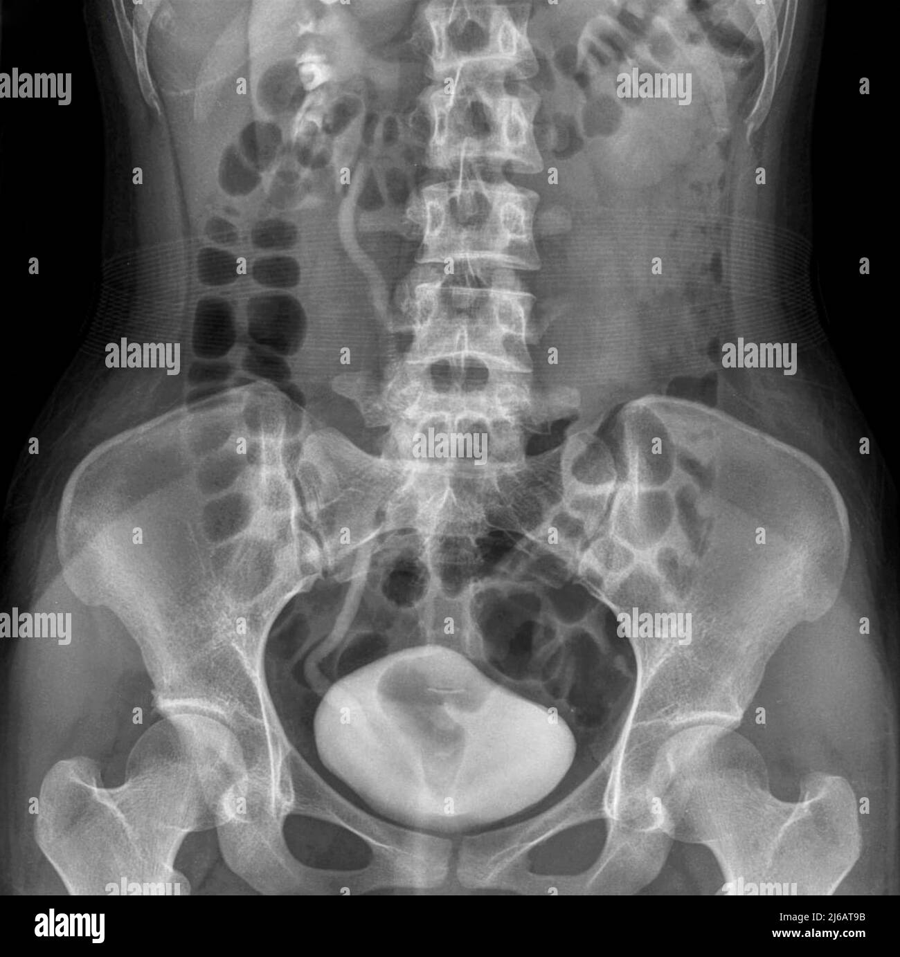Swollen kidney, Xray Stock Photo Alamy