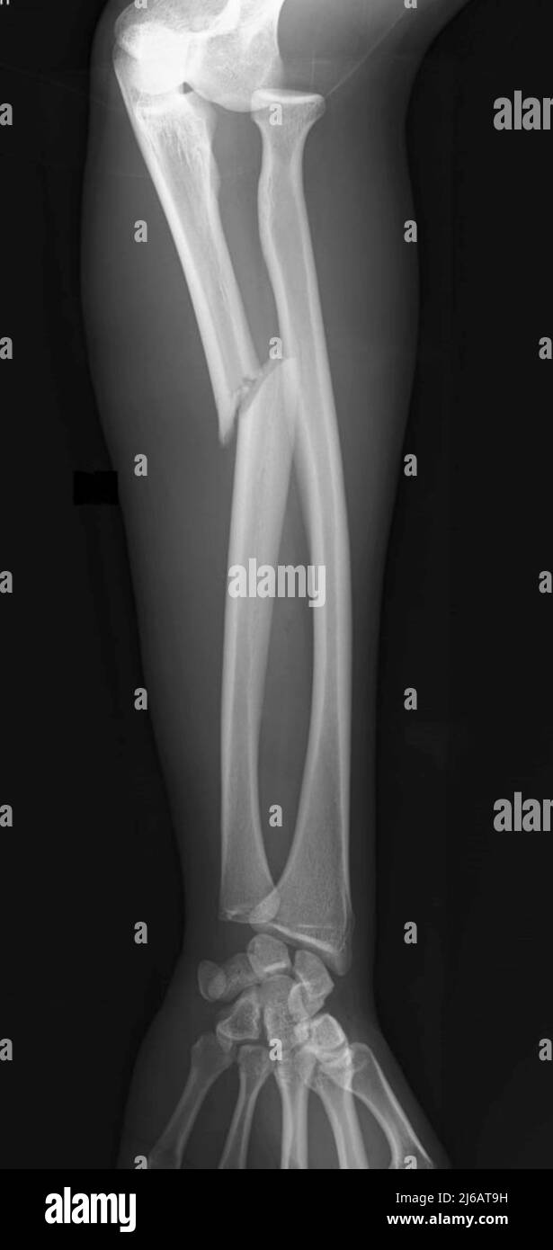 Xray of a proximal ulnar fracture with radial head dislocation, known