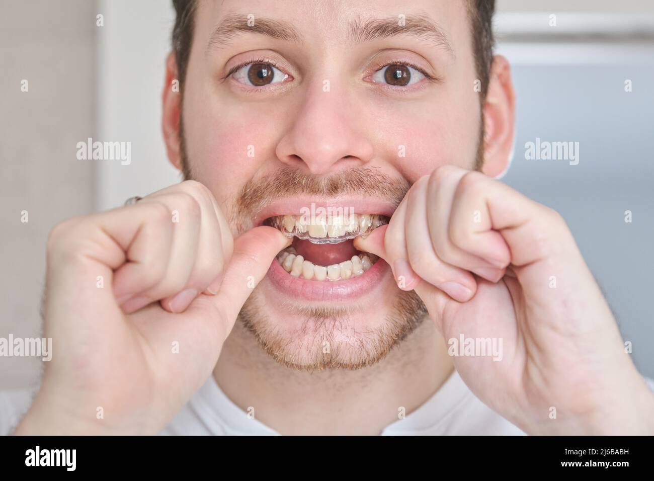 Invisible braces hires stock photography and images Alamy