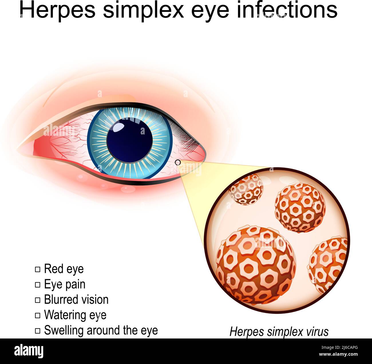 cold sores on eyes