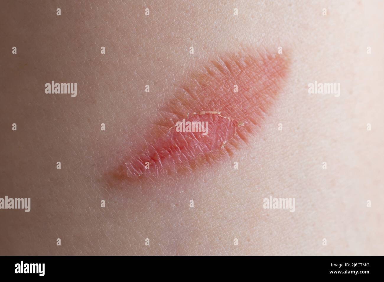 Leaf shaped burn wound on a woman's fore arm, macro skin texture Stock Photo
