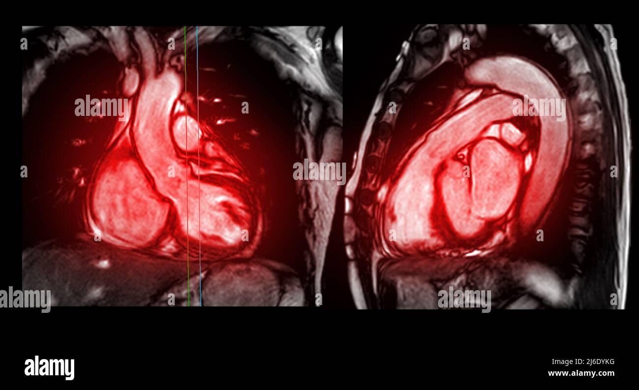 MRI heart or Cardiac MRI ( resonance imaging ) of heart