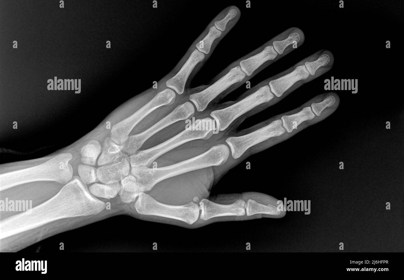 Xray of human Hand fingers top view. X-ray of male hand and wrist. X-ray of healthy whole bones of the hand close-up. Stock Photo