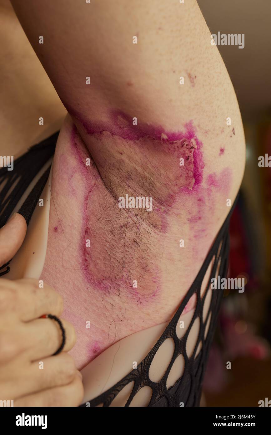 330+ Skin Condition Armpit Stock Photos, Pictures & Royalty-Free