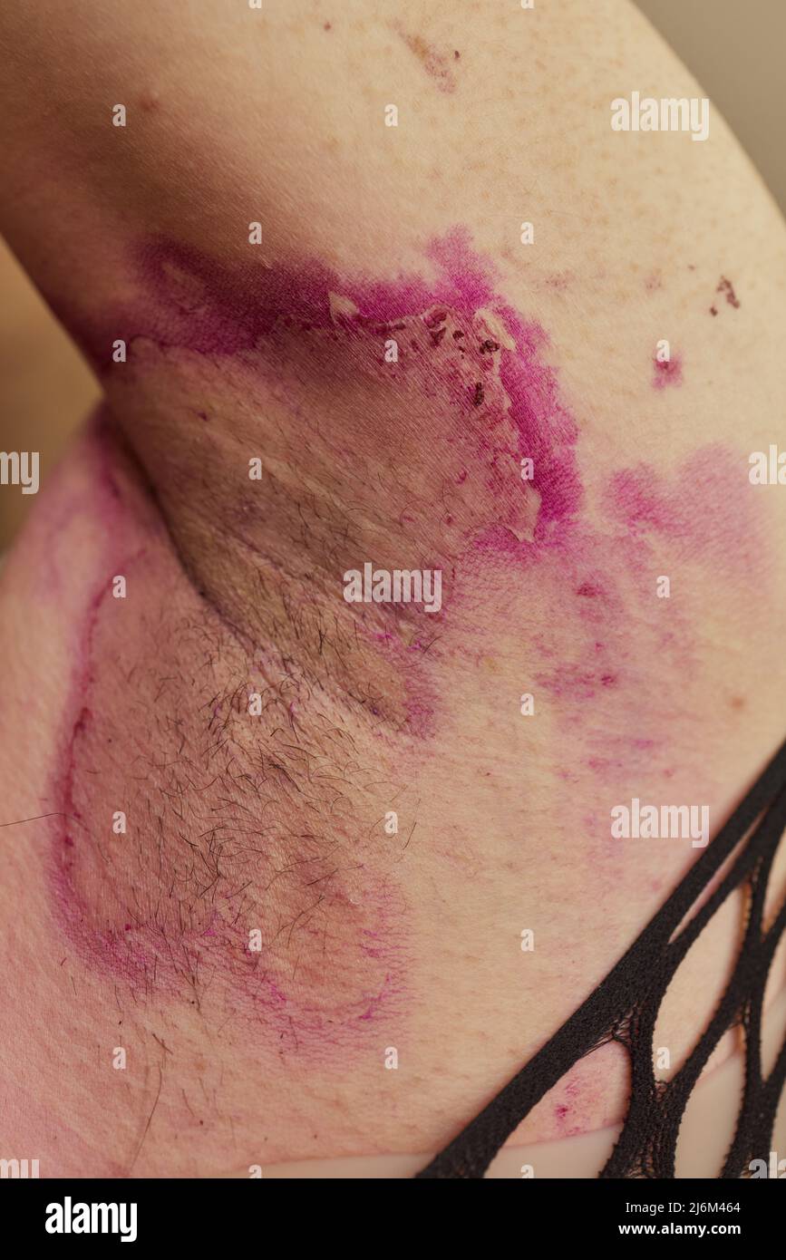 Affected skin, Armpit Underarm Rash infections ringworm, bacterial folliculitis, hidradenitis suppurativa Stock Photo
