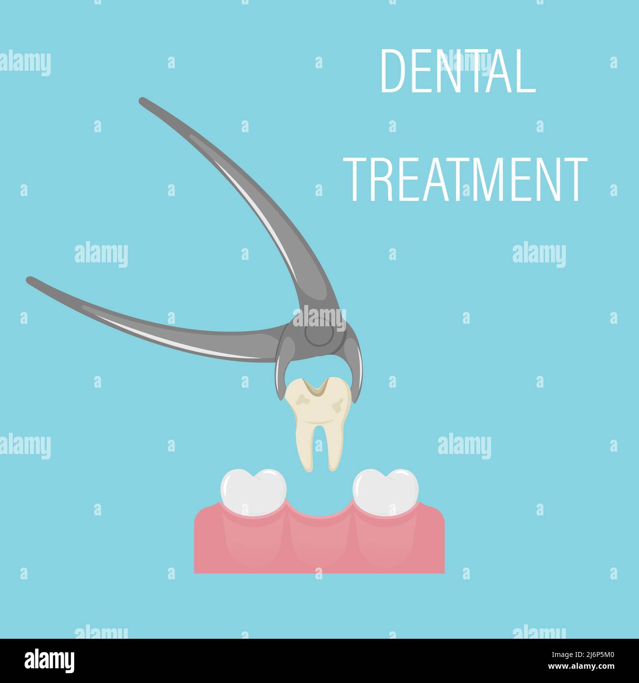 Dental tooth extraction. Exodontia. The tooth in the dental forceps. A