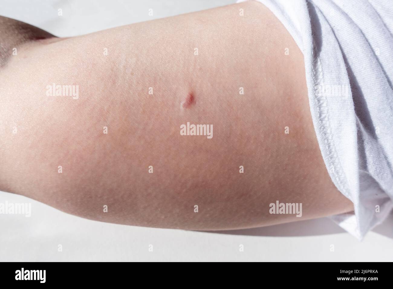 Close up view of a woman's birth control implant removal scar, several months after the device's