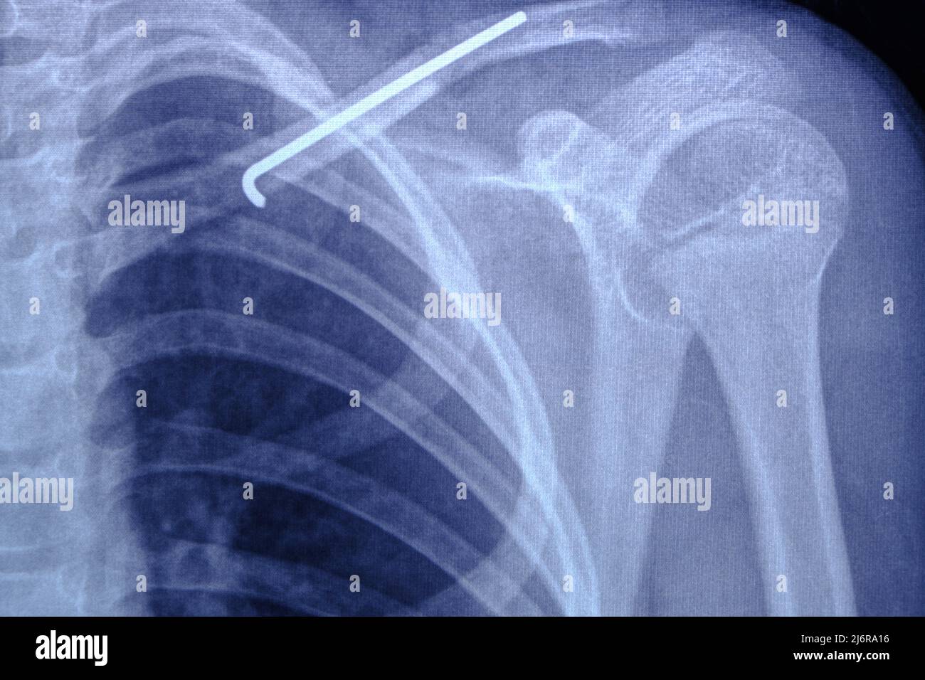 X ray image person with broken collarbone and spoke installed in it