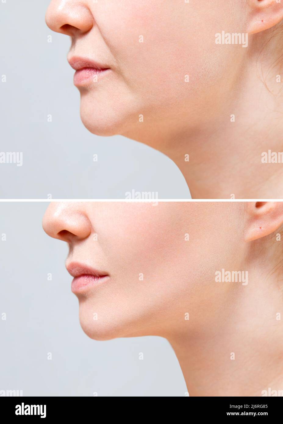 Female nasolabial fold before and after wrinkle smoothing procedures. Correction of the chin shape liposuction of the neck. The result of the Stock Photo