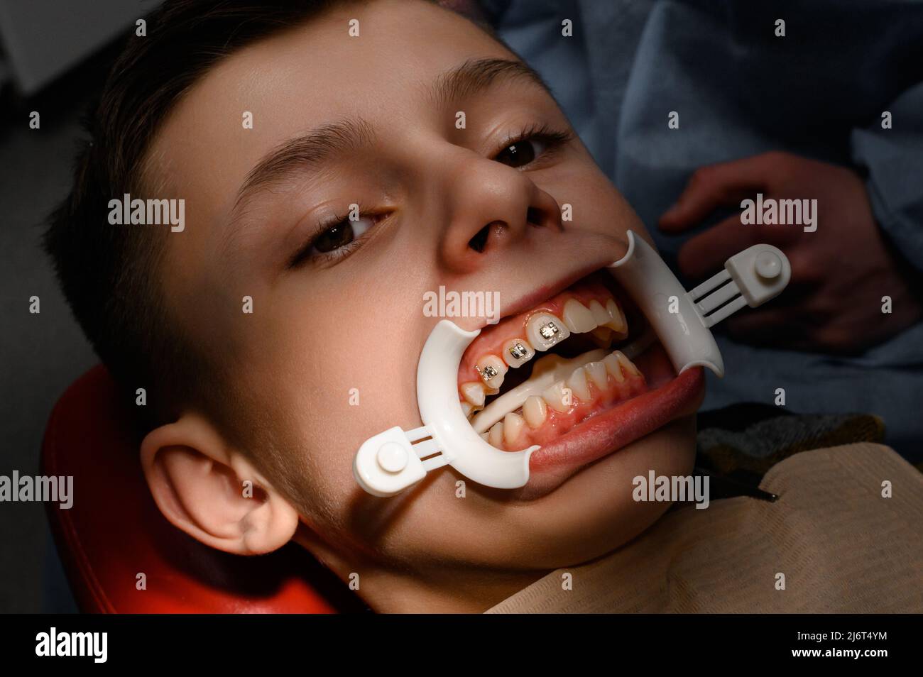 Close up of installing braces on teeth, aligning teeth with braces