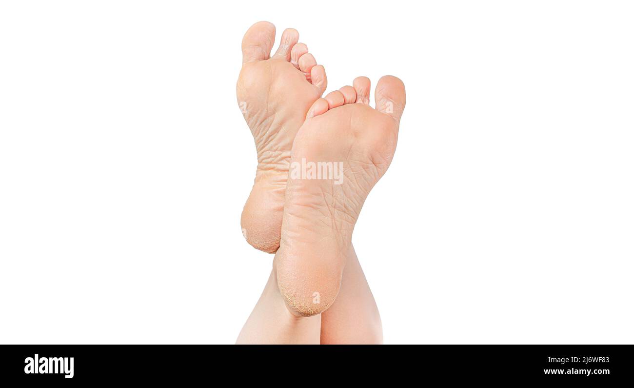 rough skin on soles of feet. dry heels, dry chapped skin on feet
