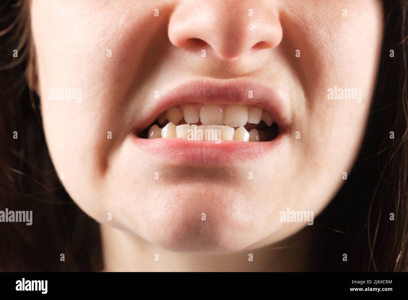 Patient with dislocated jaw and malocclusion, temporomandibular joint