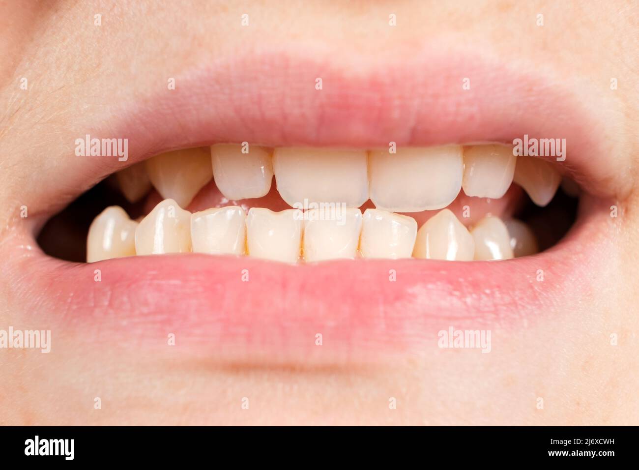 Patient with dislocated jaw and malocclusion, temporomandibular joint dysfunction, close-up. Stock Photo