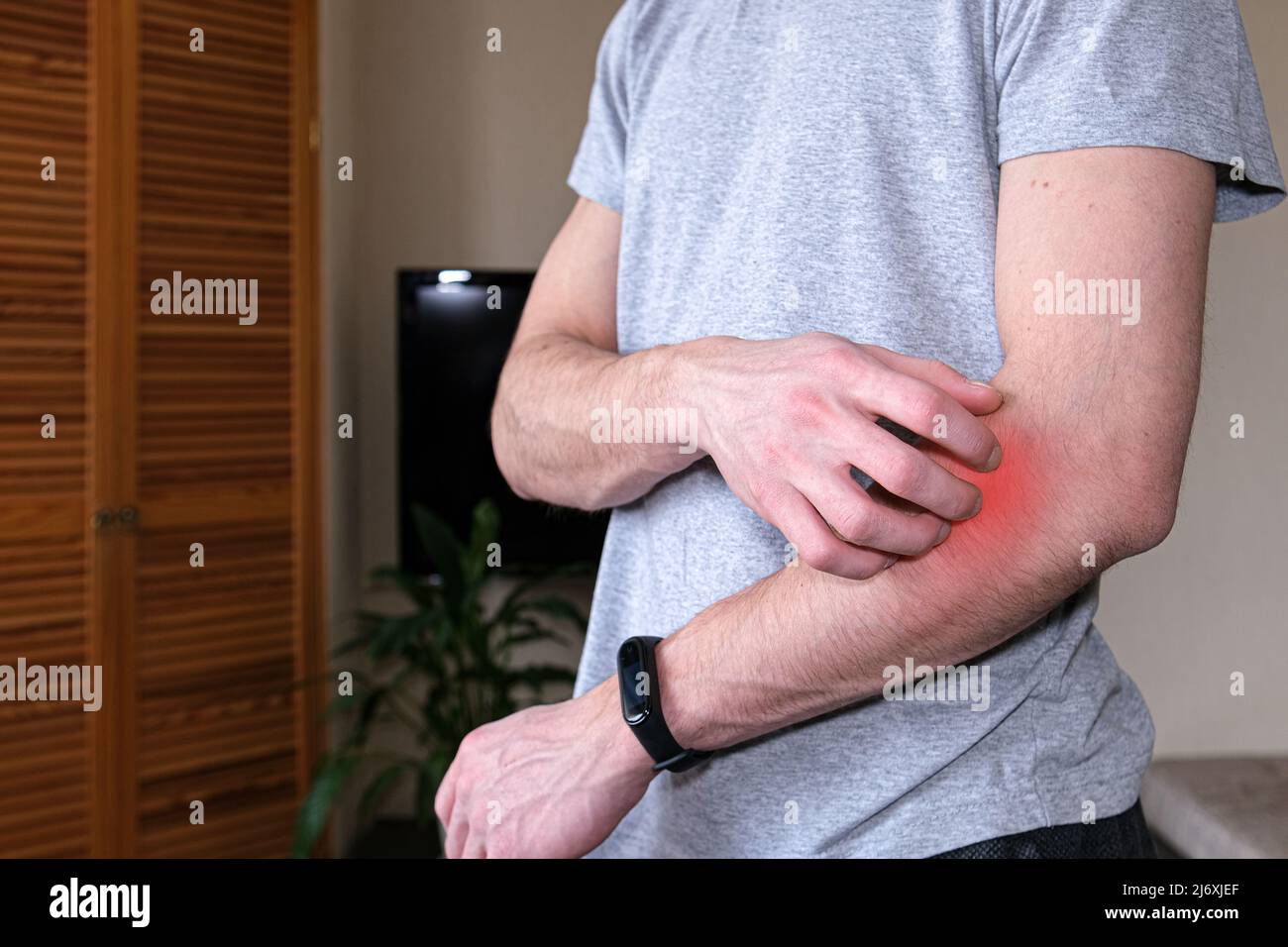 A man scratching an itchy hand. Dermatitis, eczema, allergies, psoriasis. Close-up of a man with an itchy rash on his arm, the affected area is highli Stock Photo