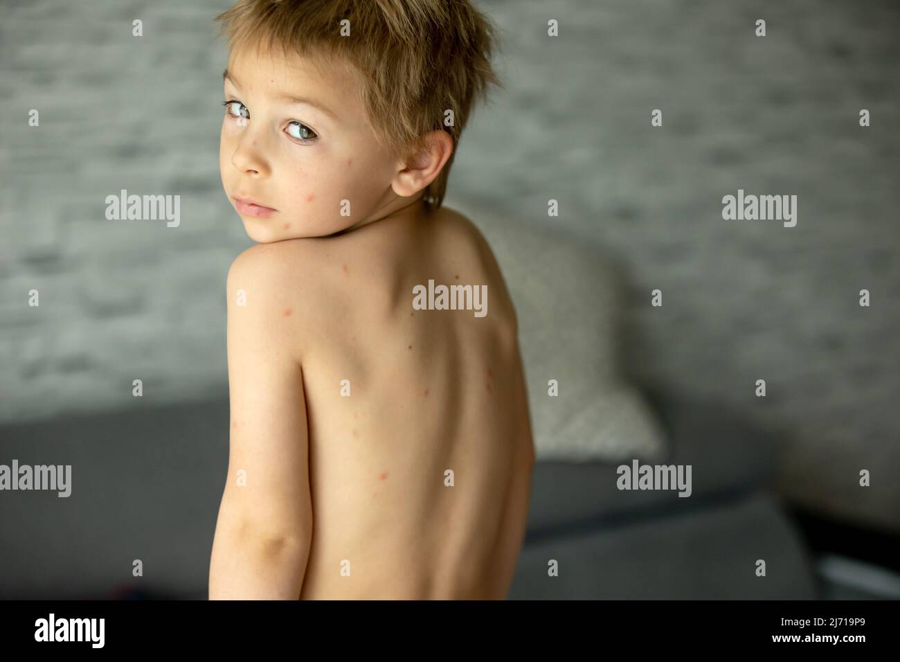 Toddler child, boy with chicken pox, mild rash, first stage of the ...