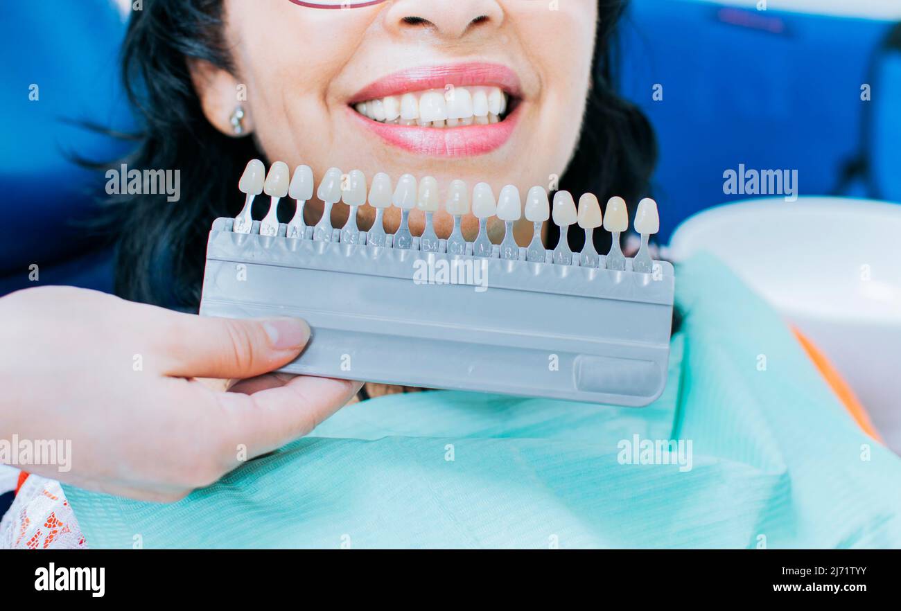 Cosmetological teeth whitening in a dental clinic, selection of the