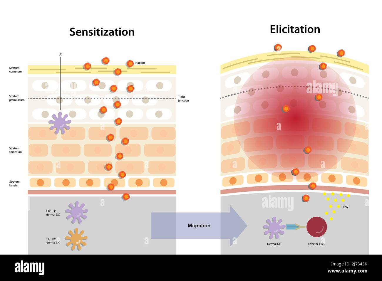 Sensitization and elicitation phases in contact allergy. Allergic contact dermatitis, contact hypersensitivity, cell–mediated inflammatory skin diseas Stock Vector