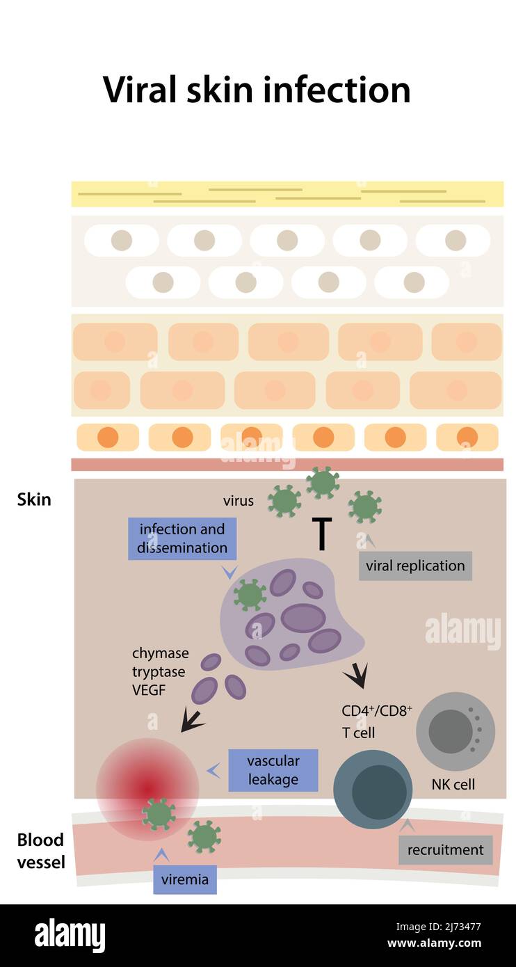 Viral skin infection. Sheme of viral replication going through processes of infection and dissemination, vascular leakage and viremia. Stock Vector