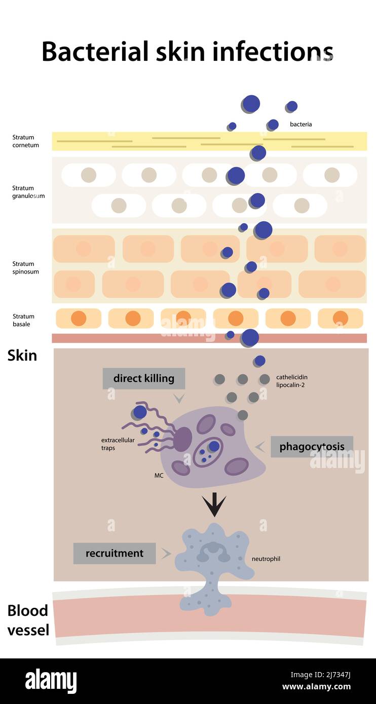 Sheme of bacterial skin infection development. Shematic visualization of phagocytosis, recruitment with neutrophil Stock Vector