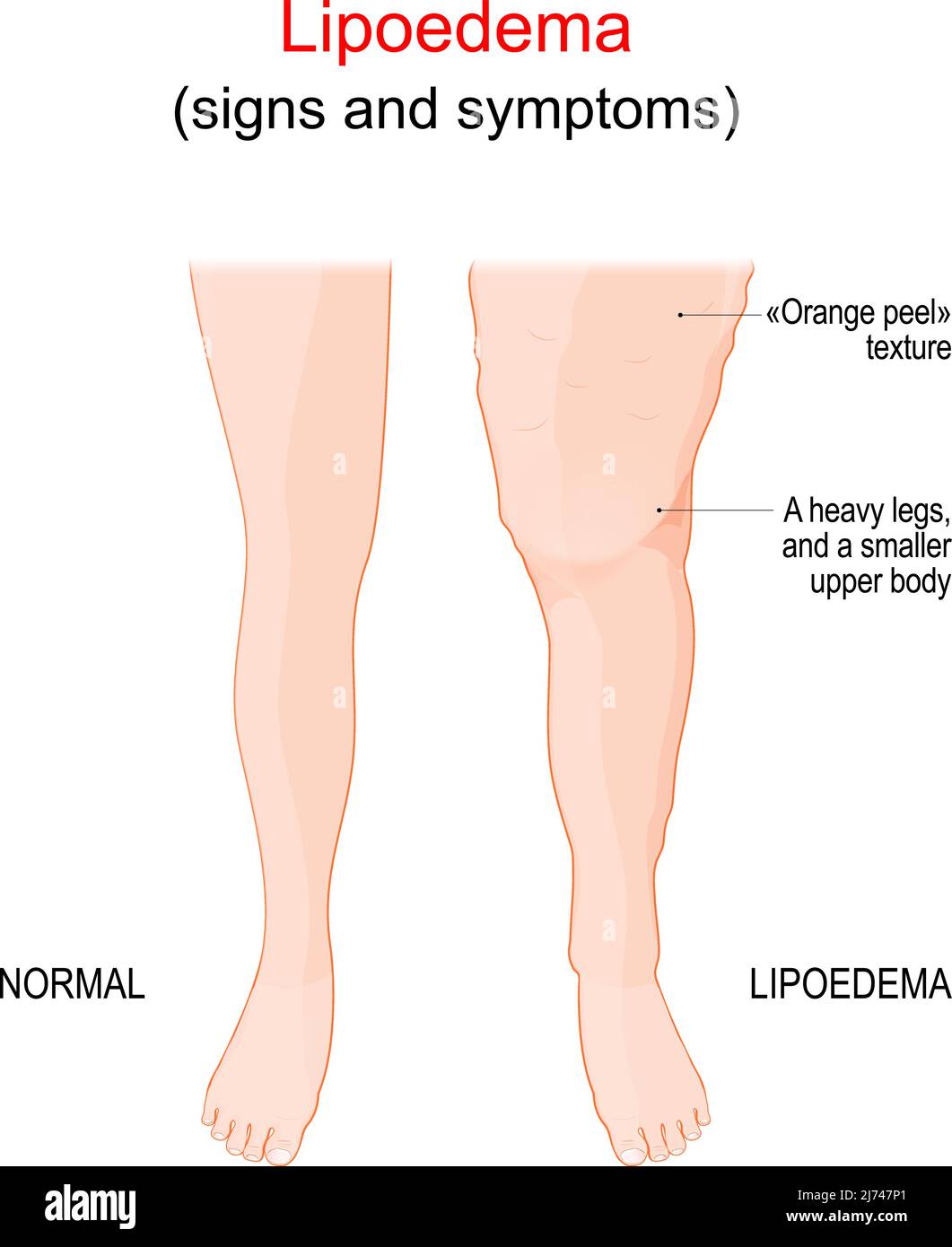 Lipoedema or Lipedema. abnormal build-up of fat in legs. difference and comparison normal healthy leg and affected leg with skin an 'orange peel' text Stock Vector
