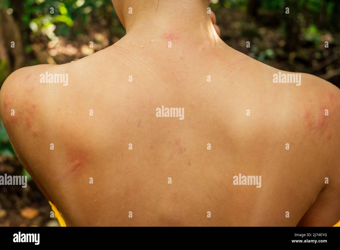 Woman with itching from biting insect in body in tropical jungle forest Stock Photo