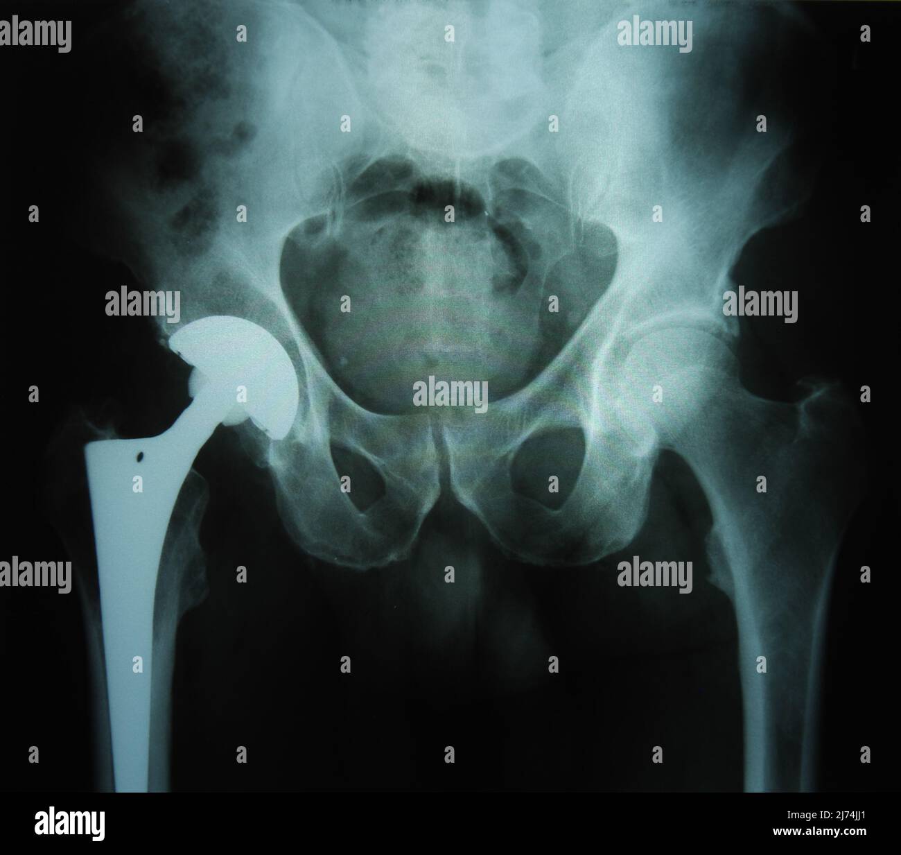 Hüfte prothese arzt hi-res stock photography and images - Alamy