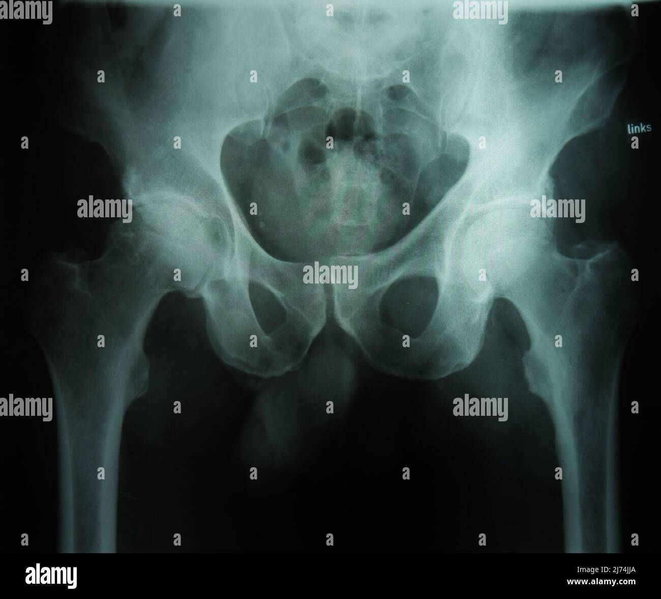 Röntgenbild der Hüfte Stock Photo - Alamy