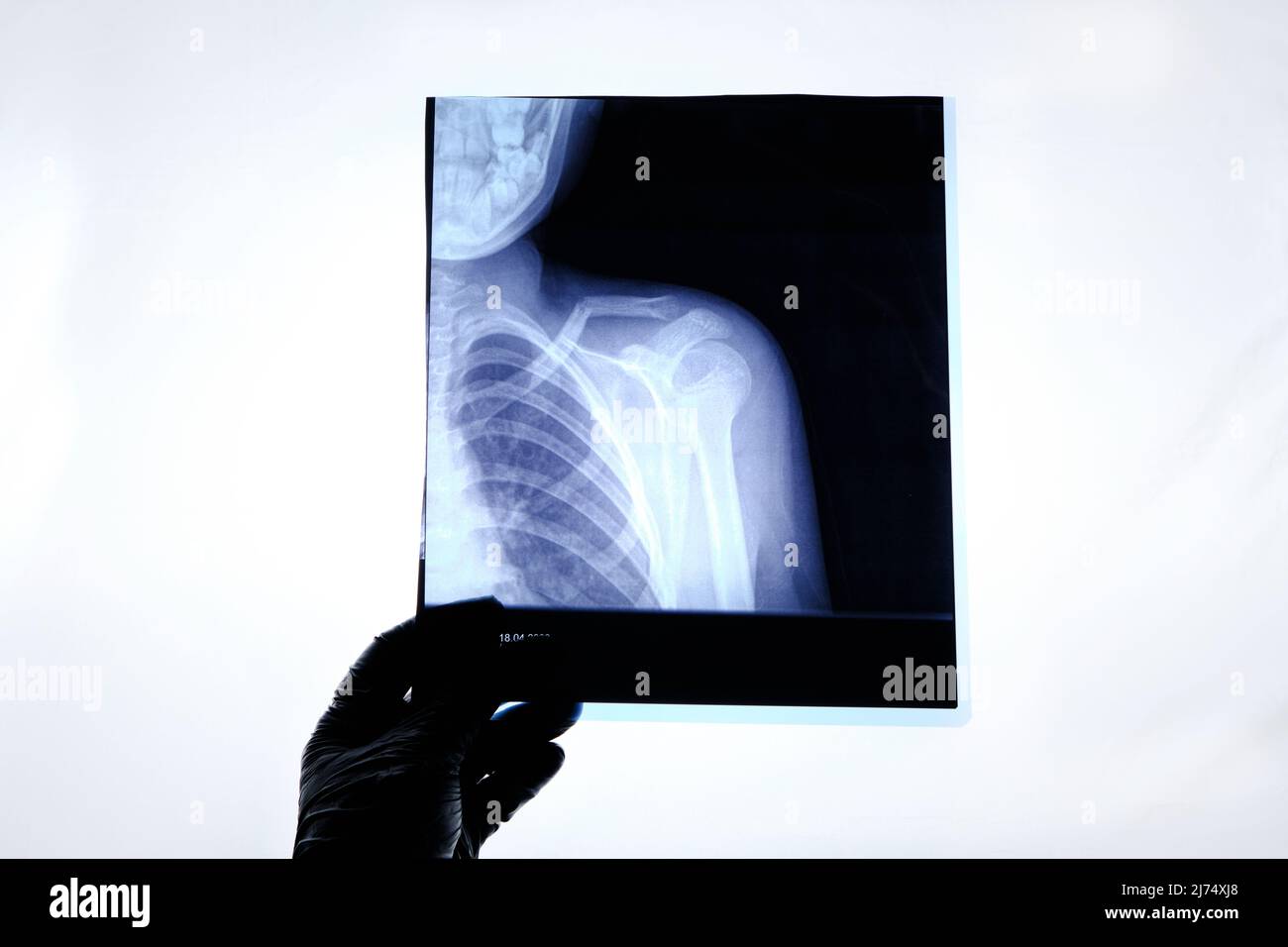 X-ray image of a man with a broken collarbone Stock Photo