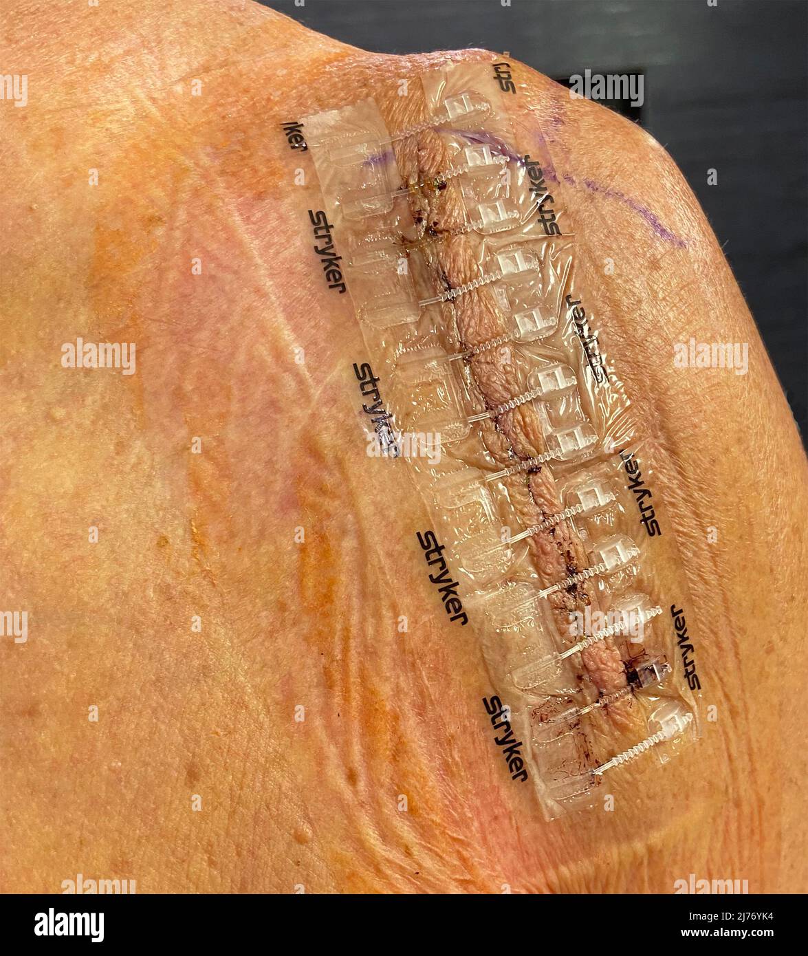New (2022) Medical plastic closure using skin shield after shoulder replacement surgery Stock Photo