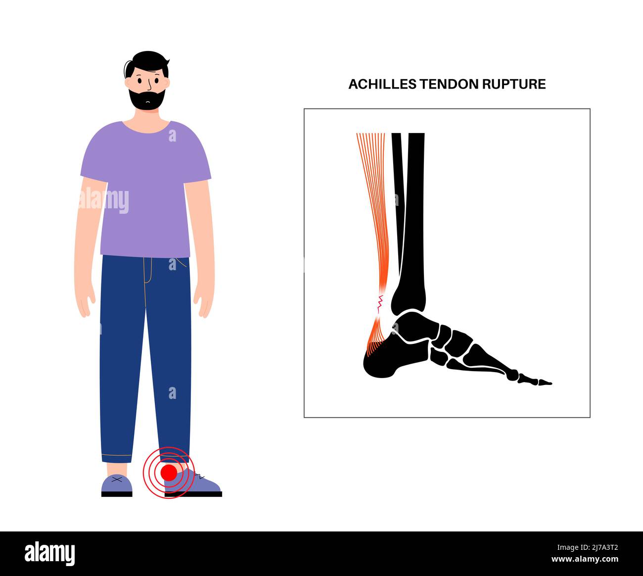 Achilles tendon injury, illustration Stock Photo