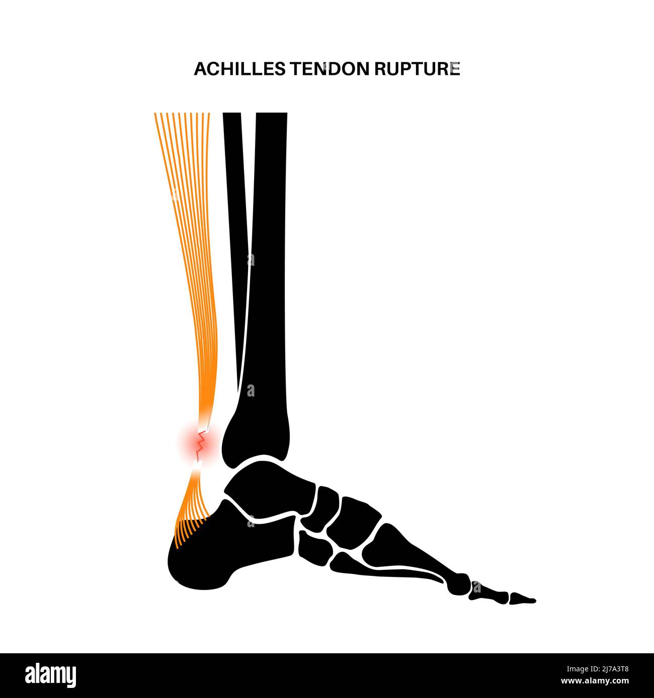 Achilles tendon injury, illustration Stock Photo Alamy