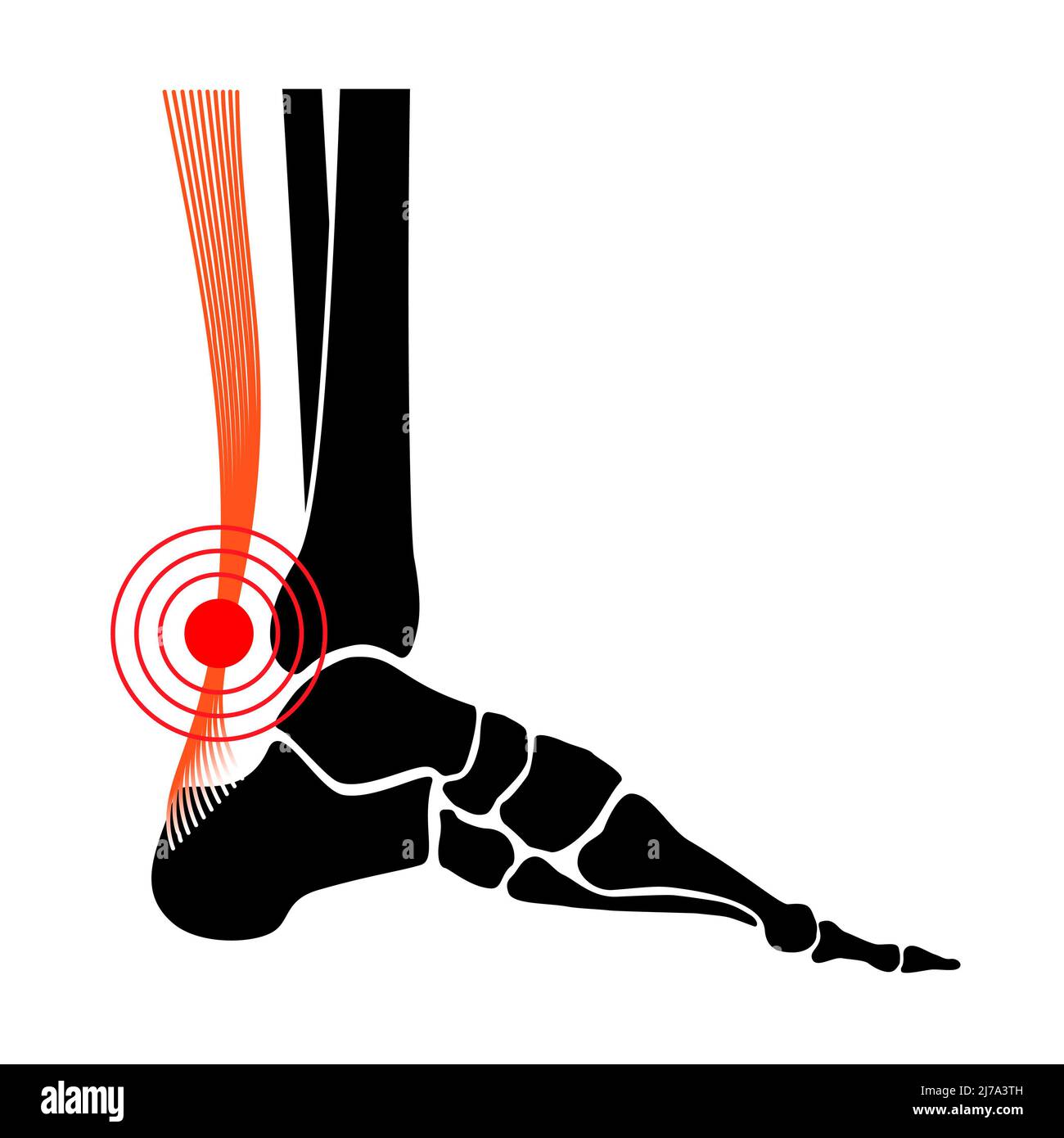 Achilles tendon injury, illustration Stock Photo Alamy