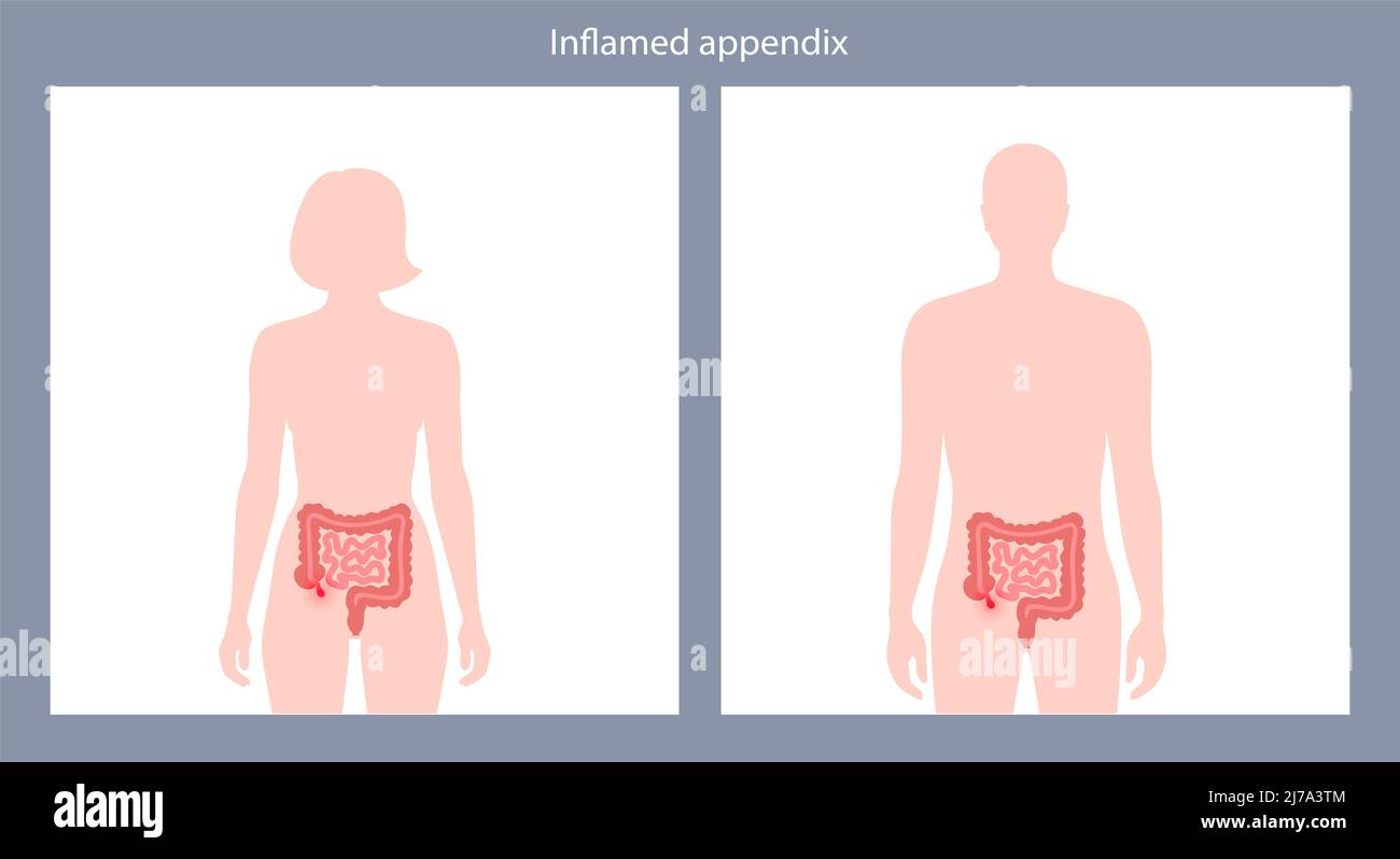 Sick Man Having Flank Pain Stock Illustration - Download Image Now - Pain,  Appendicitis, Bladder - iStock